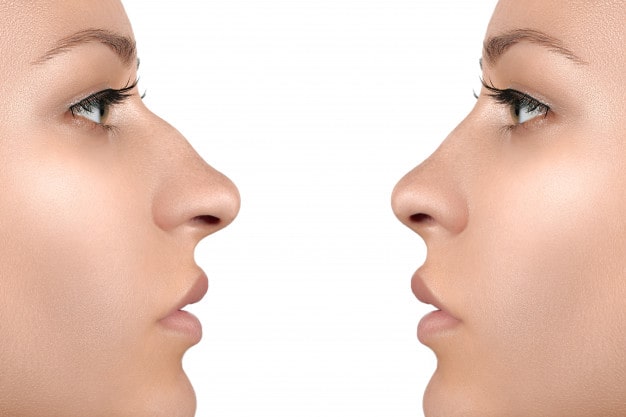 Rinoplastia Medellín, cirugia de nariz medellin