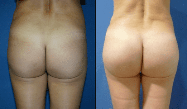 Buttock augmentation 3