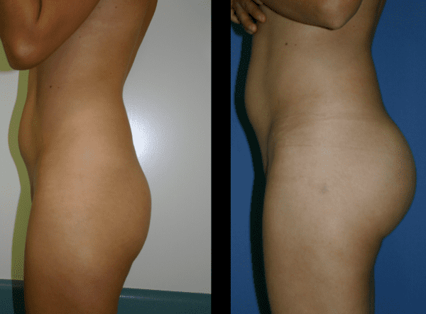Buttock augmentation