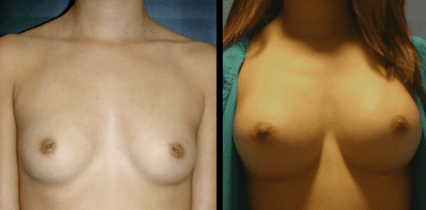 Breast Implants 2