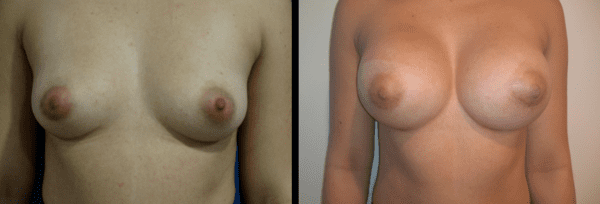 Breast Implants 1