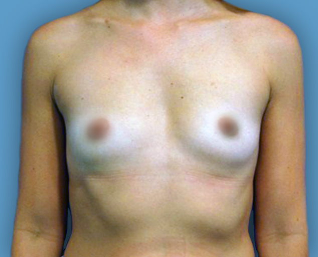 Antes cirugía de mamoplastia de aumento