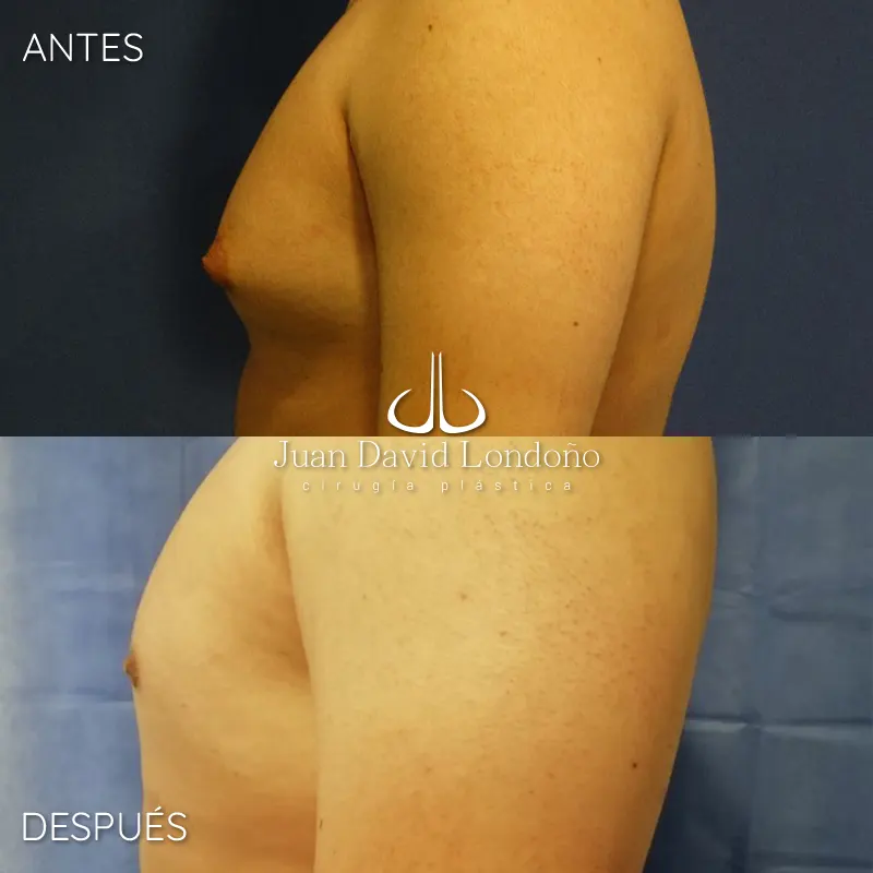 Img-Dr_Juan_David_Londono-Antes&Despues-HOR-2025-Ginecomastia 1