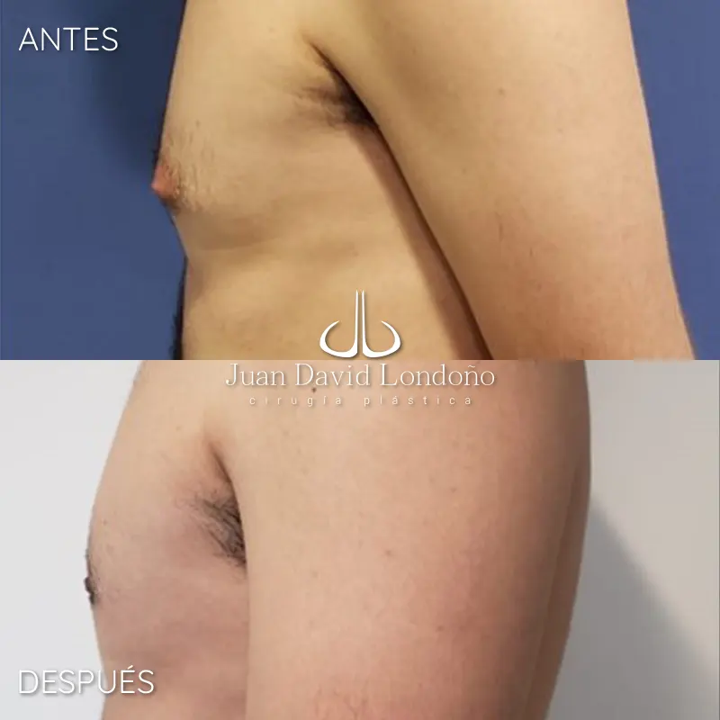 Img-Dr_Juan_David_Londono-Antes&Despues-HOR-2025-Ginecomastia 2