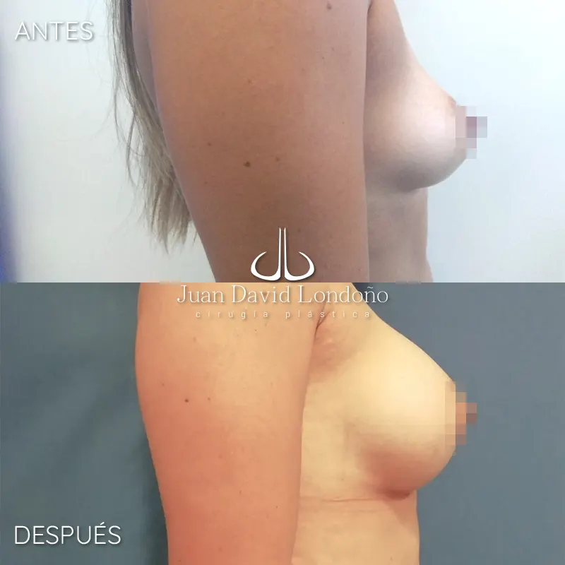 Img-Dr_Juan_David_Londono-Antes&Despues-HOR-2025-Mamoplastia Aumento 6