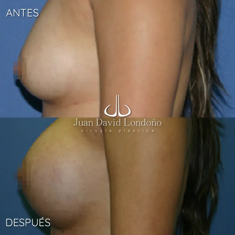 Img-Dr_Juan_David_Londono-Antes&Despues-HOR-2025-Mamoplastia Aumento 7