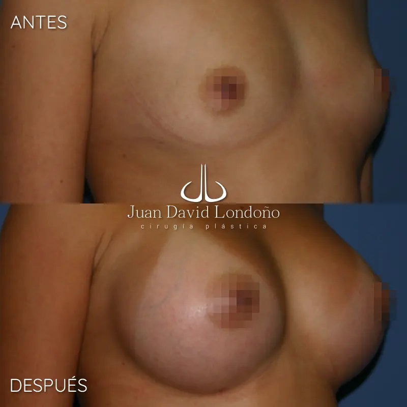 Img-Dr_Juan_David_Londono-Antes&Despues-HOR-2025-Mamoplastia Aumento 8