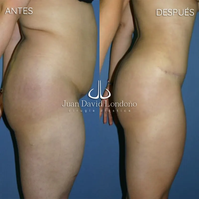 Img-Dr_Juan_David_Londono-Antes&Despues-VER-2025-Abdominoplastia 1