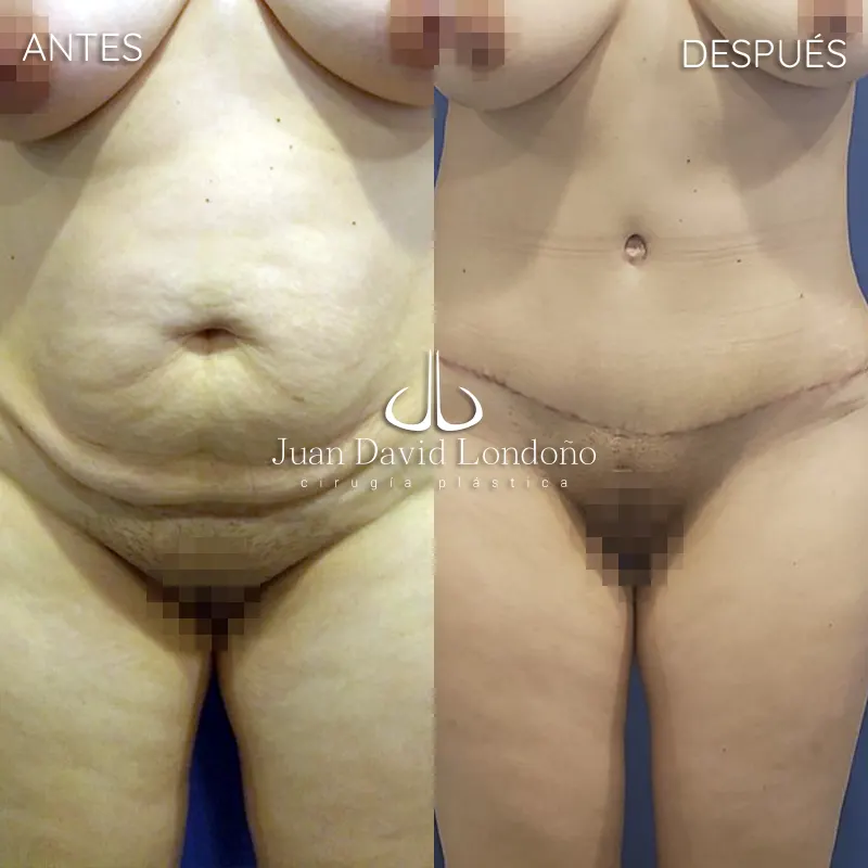 Img-Dr_Juan_David_Londono-Antes&Despues-VER-2025-Abdominoplastia 2