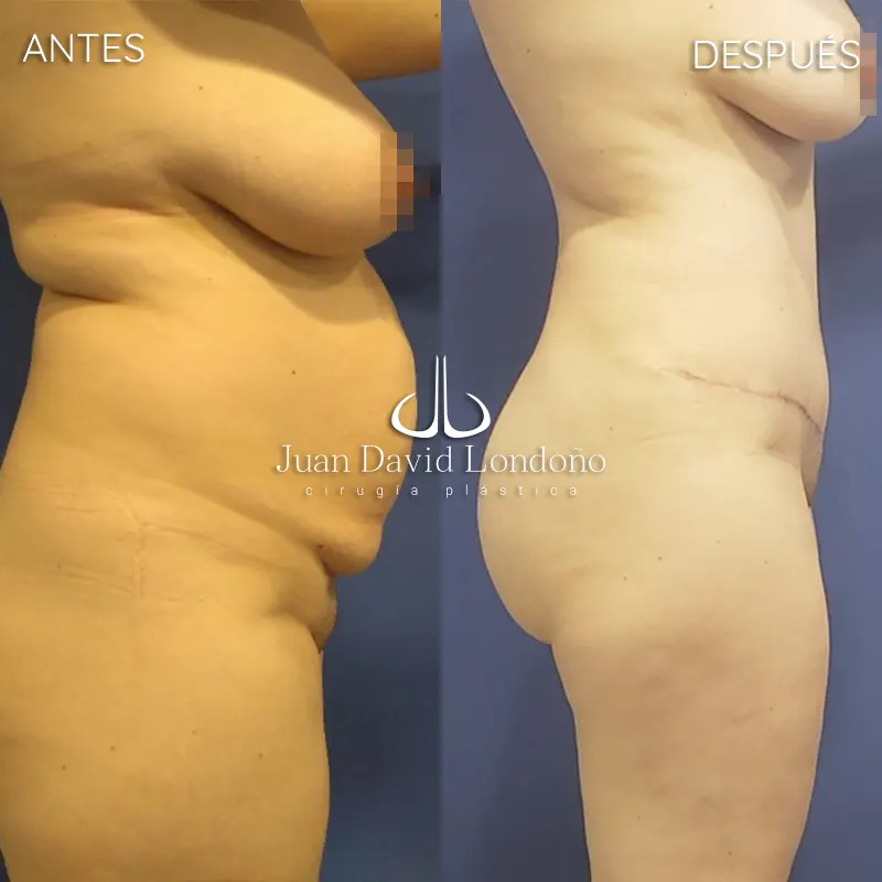 Img-Dr_Juan_David_Londono-Antes&Despues-VER-2025-Abdominoplastia 3