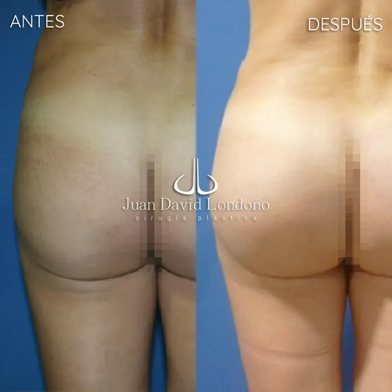 Img-Dr_Juan_David_Londono-Antes&Despues-VER-2025-Gluteoplastia 1