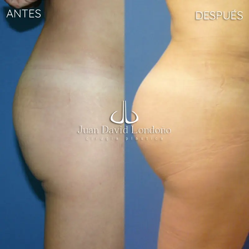 Img-Dr_Juan_David_Londono-Antes&Despues-VER-2025-Gluteoplastia 2