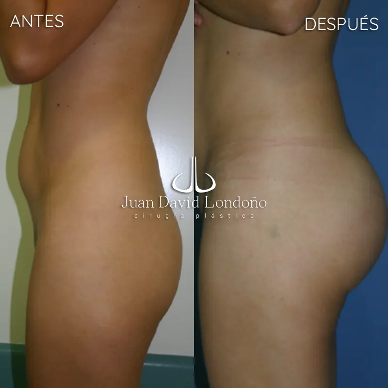 Img-Dr_Juan_David_Londono-Antes&Despues-VER-2025-Gluteoplastia 3