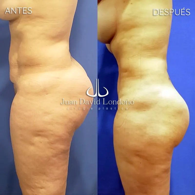 Img-Dr_Juan_David_Londono-Antes&Despues-VER-2025-Lipo 1
