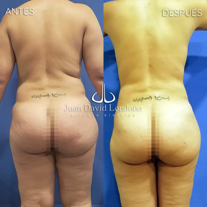 Img-Dr_Juan_David_Londono-Antes&Despues-VER-2025-Lipo 2