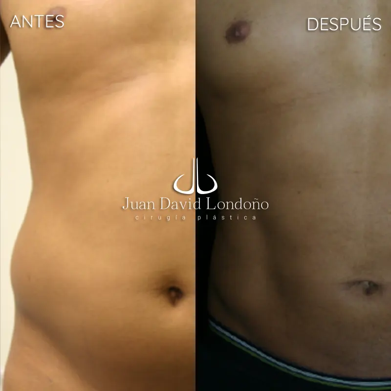 Img-Dr_Juan_David_Londono-Antes&Despues-VER-2025-Lipo 3