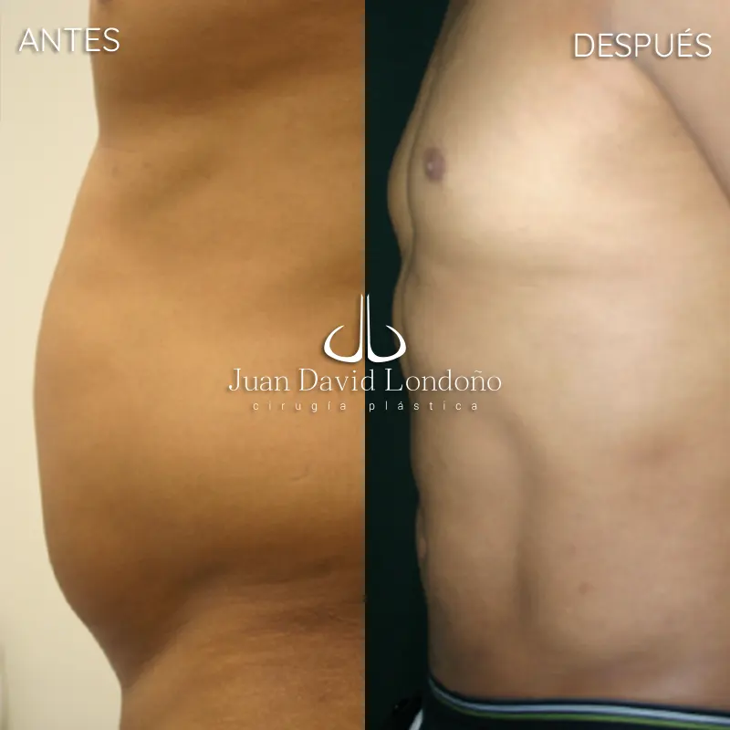 Img-Dr_Juan_David_Londono-Antes&Despues-VER-2025-Lipo 4