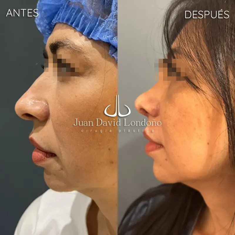 Img-Dr_Juan_David_Londono-Antes&Despues-VER-2025-Rinoplastia 1