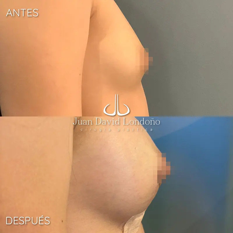 Img-Dr_Juan_David_Londono-Antes&Despues-HOR-2025-Mamoplastia Aumento 14 Img-Dr_Juan_David_Londono-Antes&Despues-HOR-2025-Mamoplastia Aumento 14
