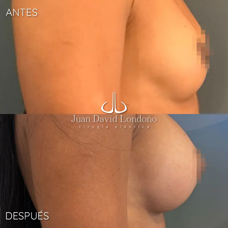 Img-Dr_Juan_David_Londono-Antes&Despues-HOR-2025-Mamoplastia Aumento 15 Img-Dr_Juan_David_Londono-Antes&Despues-HOR-2025-Mamoplastia Aumento 15