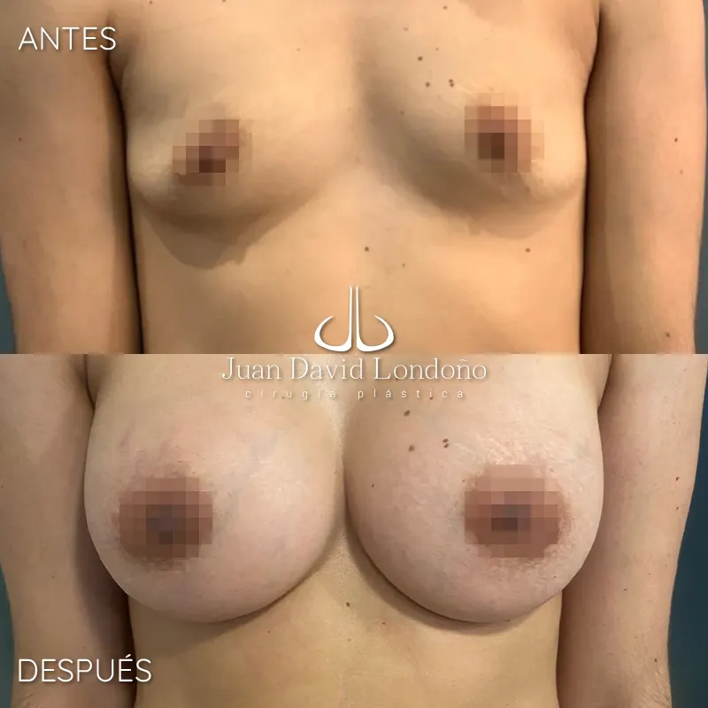 Img-Dr_Juan_David_Londono-Antes&Despues-HOR-2025-Mamoplastia Aumento 16 Img-Dr_Juan_David_Londono-Antes&Despues-HOR-2025-Mamoplastia Aumento 16