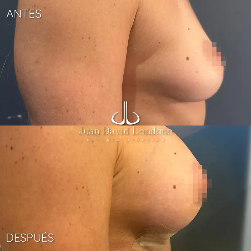 Img-Dr_Juan_David_Londono-Antes&Despues-HOR-2025-Mamoplastia Aumento 17 Img-Dr_Juan_David_Londono-Antes&Despues-HOR-2025-Mamoplastia Aumento 17