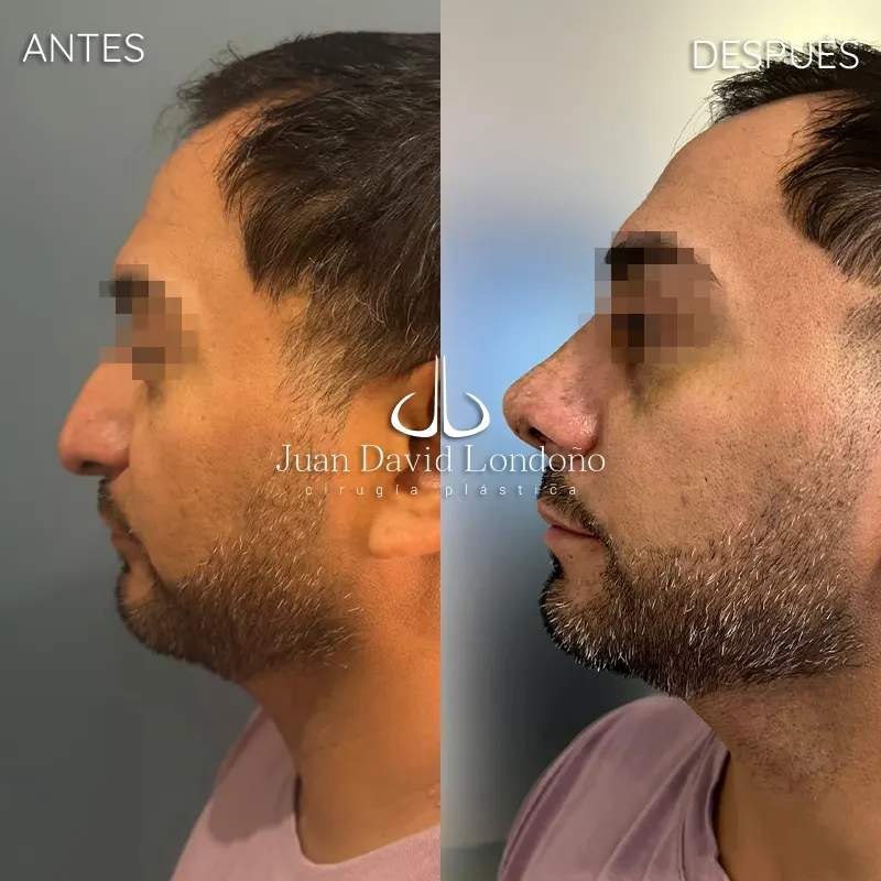 Img-Dr_Juan_David_Londono-Antes&Despues-VER-2025-Rinoplastia 3 Img-Dr_Juan_David_Londono-Antes&Despues-VER-2025-Rinoplastia 3