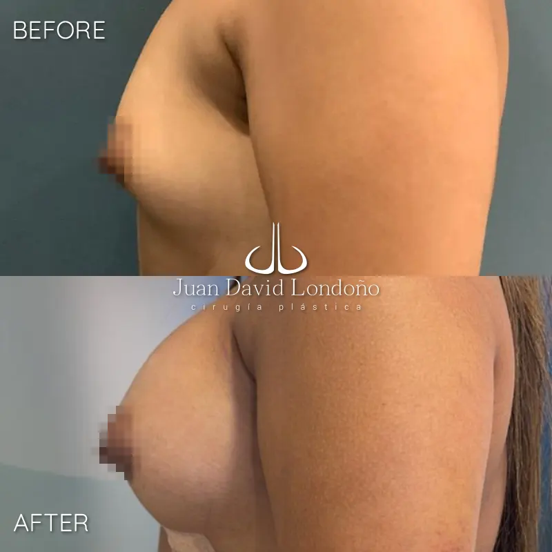 Img-Dr_Juan_David_Londono-Before&After-Breast_Augmentation-20 Img-Dr_Juan_David_Londono-Before&After-Breast_Augmentation-20