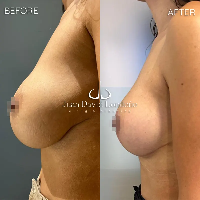 Img-Dr_Juan_David_Londono-Before&After-Breast_Reduction-1 Img-Dr_Juan_David_Londono-Before&After-Breast_Reduction-1