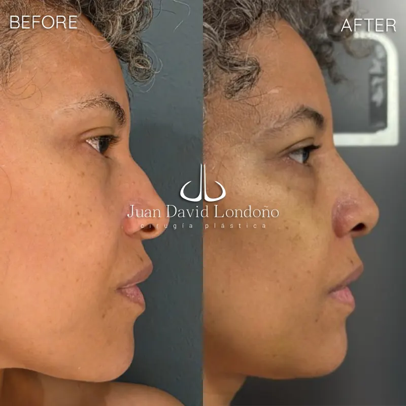 Img-Dr_Juan_David_Londono-Before&After-Rhinoplasty-4 Img-Dr_Juan_David_Londono-Before&After-Rhinoplasty-4