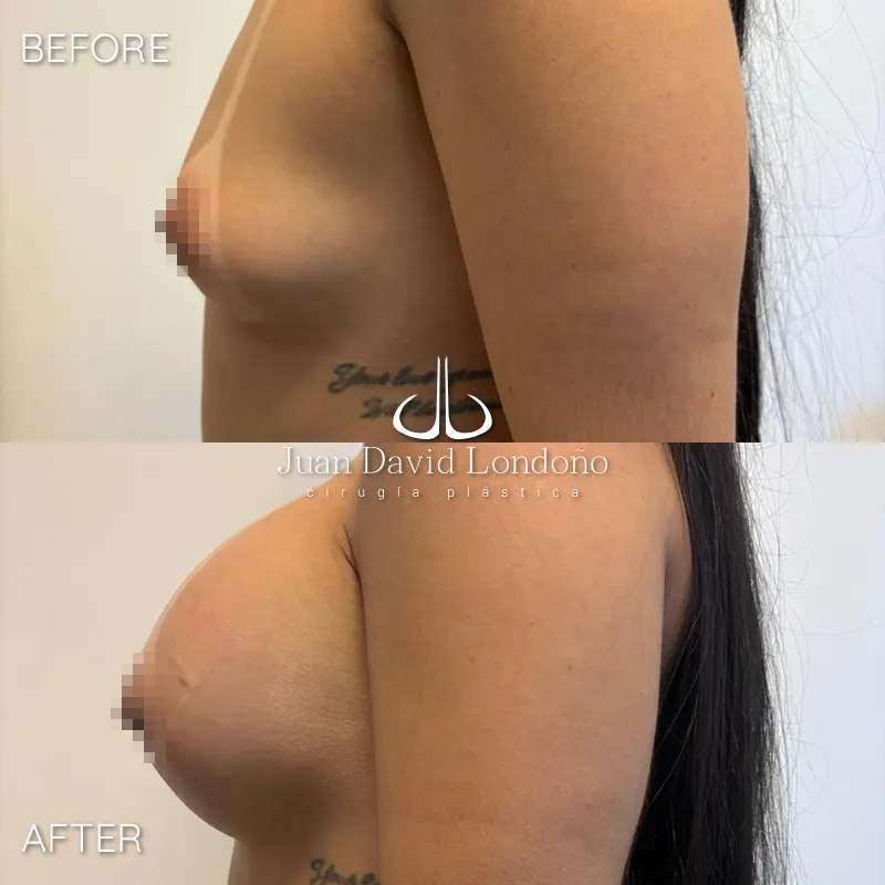 Img-Dr_Juan_David_Londono-Before&After-Breast_Augmentation-22 Img-Dr_Juan_David_Londono-Before&After-Breast_Augmentation-22